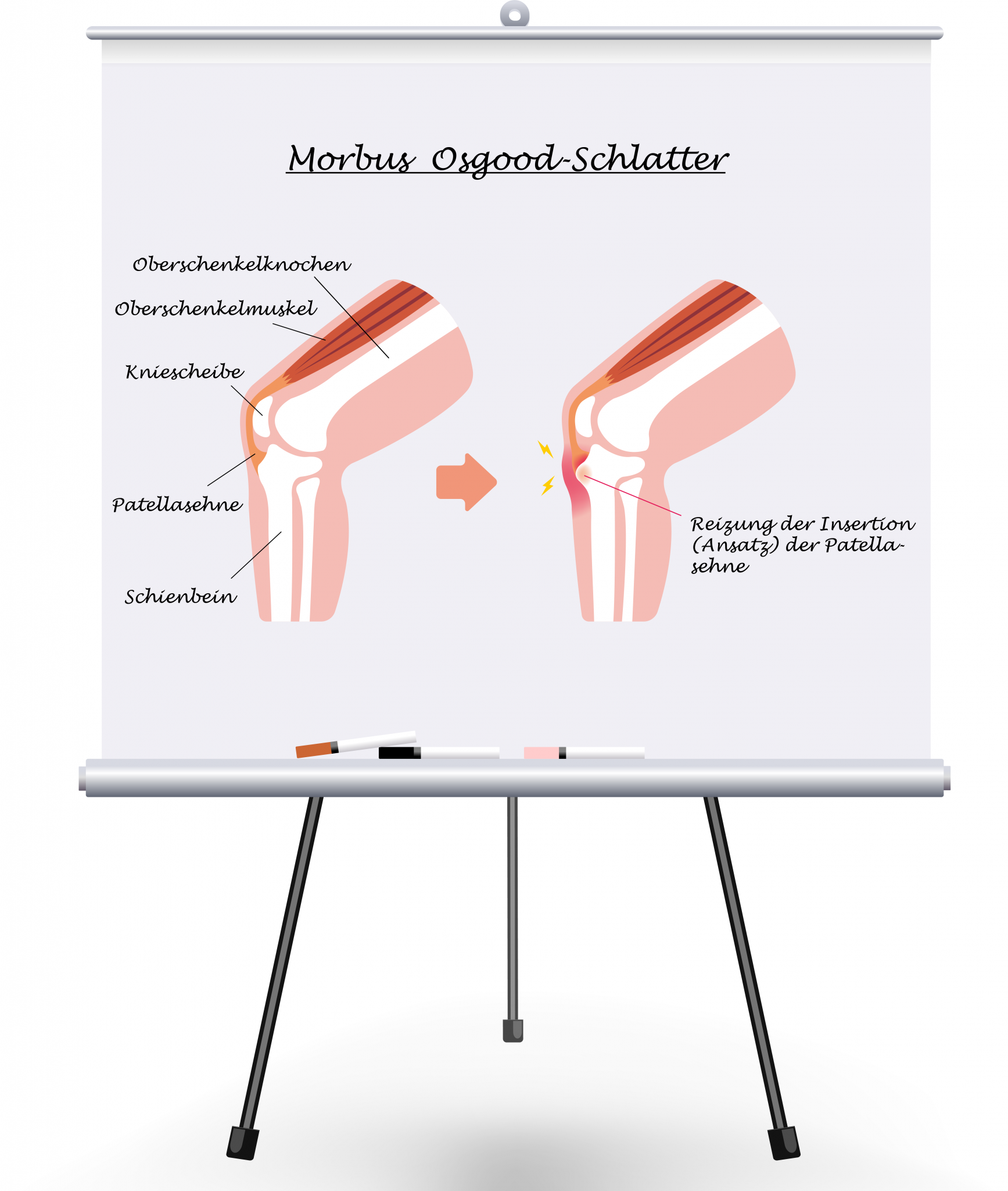 DMSO bei M. Osgood Schlatter - PraNatu